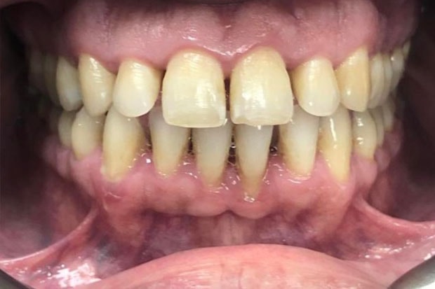 Before And After - Watford Smiles - Dentist Watford